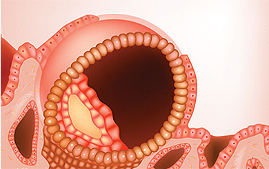 자궁내막 수용성 분석 (Endometrial Receptivity Analysis, ERA)