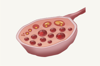 다낭성 난소