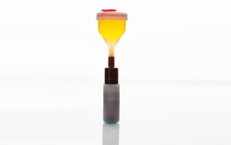 자궁내 혈소판풍부혈장 주입술 (Platelet Rich Plasma Injection)