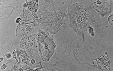 미성숙 난자 체외 성숙 기법 (In Vitro Maturation, IVM)